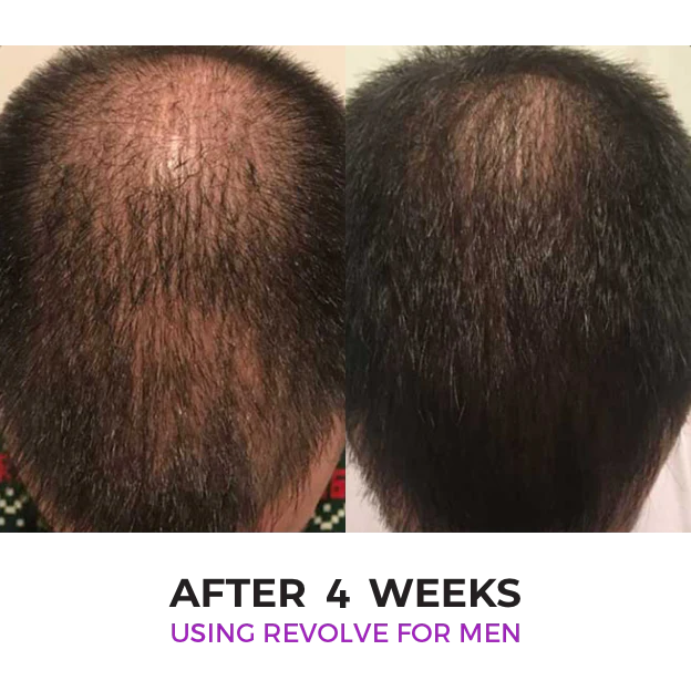 Zenagen Revolve Hair Loss Shampoo Treatment for Men-see first results in 2-6-weeks