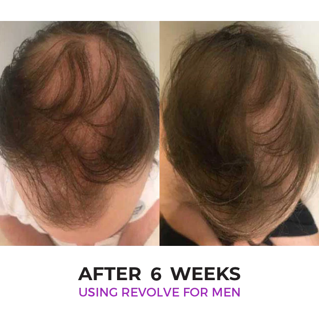 Zenagen Revolve Hair Loss Shampoo Treatment for Men-see first results in 2-6-weeks