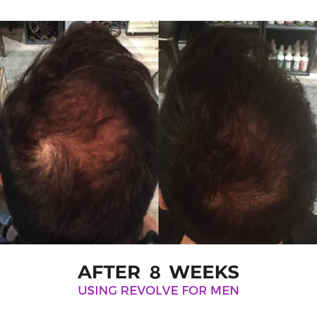 Zenagen Revolve Hair Loss Shampoo Treatment for Men-see first results in 2-6-weeks